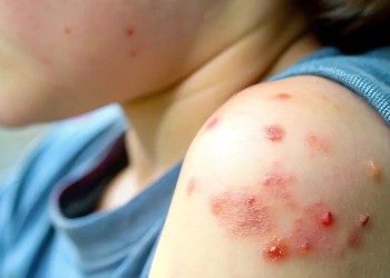 Alerta por brote de sarampión: “Es la enfermedad más contagiosa que existe”