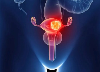 Día del Cáncer de Ovario: síntomas y cómo prevenirlo