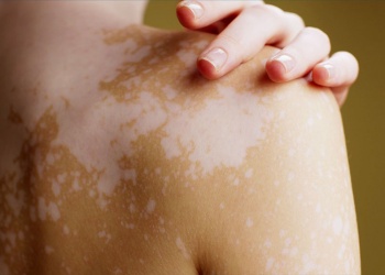 Luz sobre el vitiligo: charla abierta con profesionales