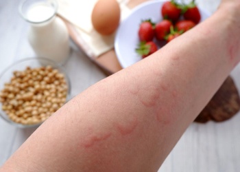 Alergia alimentaria: una condición en aumento que afecta al 10% de los niños en Argentina