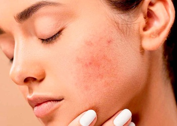 Dermatitis atópica: una enfermedad subdiagnosticada que impacta la vida cotidiana