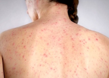 “¡Vacuná a tu hijo, ya!”: desesperado pedido del Ministro de Salud por el brote de sarampión