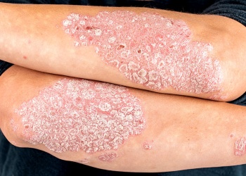 Médicos especialistas ofrecen turnos gratuitos para la detección de psoriasis