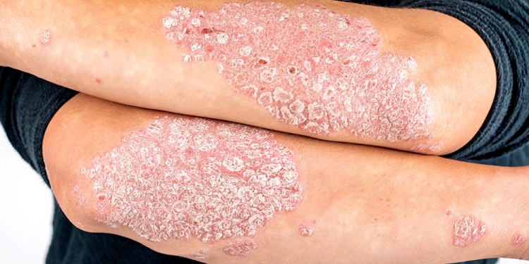 PSORIASIS. Es una enfermedad inflamatoria no contagiosa, se presenta en forma de lesiones rojas, cubiertas por escamas blancas y secas.