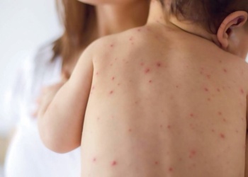 Argentina ajusta el calendario de vacunación y adelanta la segunda dosis contra el sarampión