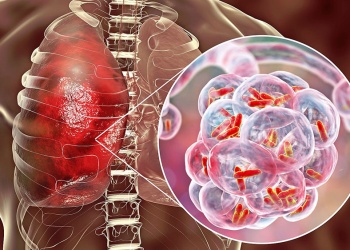 Ya son 13.794 los casos de tuberculosis en Argentina durante 2025: qué regiones impulsan el aumento