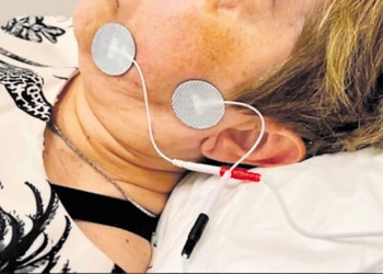 Parálisis facial: electroestimulación reduce el tiempo de recuperación