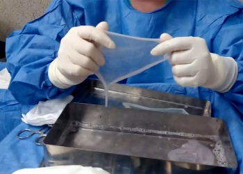 Placentas: antes iban a la basura patológica y hoy ayudan a tratar quemados y ulcerados