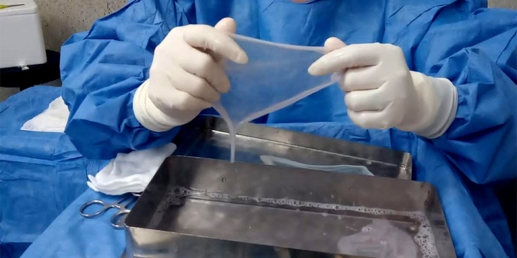 MANOS MAESTRAS. El instrumentador quirúrgico cumple un rol clave para separar la capa amniótica de la placenta.