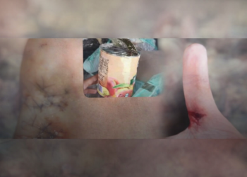 Una lata mal descartada casi le cuesta un dedo a un recolector en Eldorado