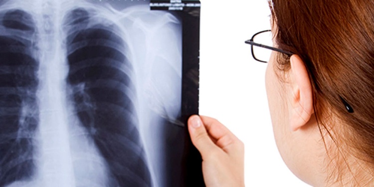 TIEMPO PERDIDO SIN TRATAMIENTO. El retraso en el diagnóstico continúa siendo uno de los principales desafíos.