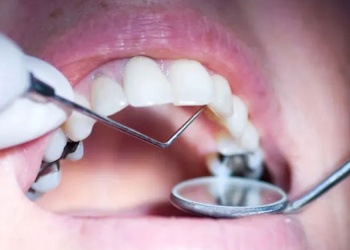 La mayoría de la población tiene pastas de mercurio en sus dientes