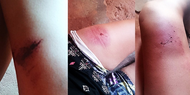 EVIDENCIAS EN LA PIEL. Los estudiantes de la Escuela 887 con las secuelas de los asaltos que sufrieron la semana pasada y con autores que no fueron detenidos.