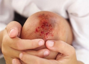 Nuevo tratamiento para la hemofilia ya está disponible en Argentina