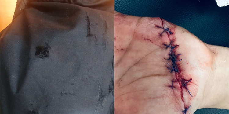 TENDONES COMPROMETIDOS. La mochila cortada y la mano con varios puntos.