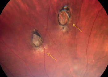 Toxoplasmosis, una infección frecuente que puede prevenirse desde las aulas