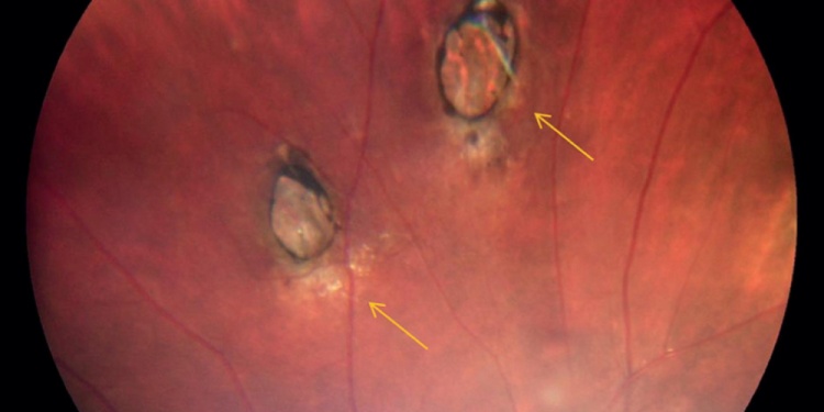 OJOS. La toxoplasmosis ocular puede causar pérdida permanente de la visión.