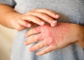 Campaña nacional busca reducir el subdiagnóstico de la dermatitis atópica con consultas gratuitas