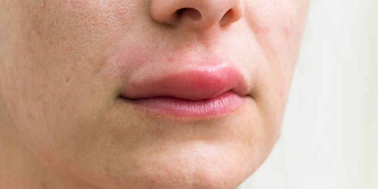 Close-up photo of the womans swollen lip from an alergic attack. Horizontal framing
