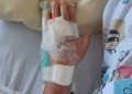Aumentaron los casos de quemaduras en niños menores de 3 años