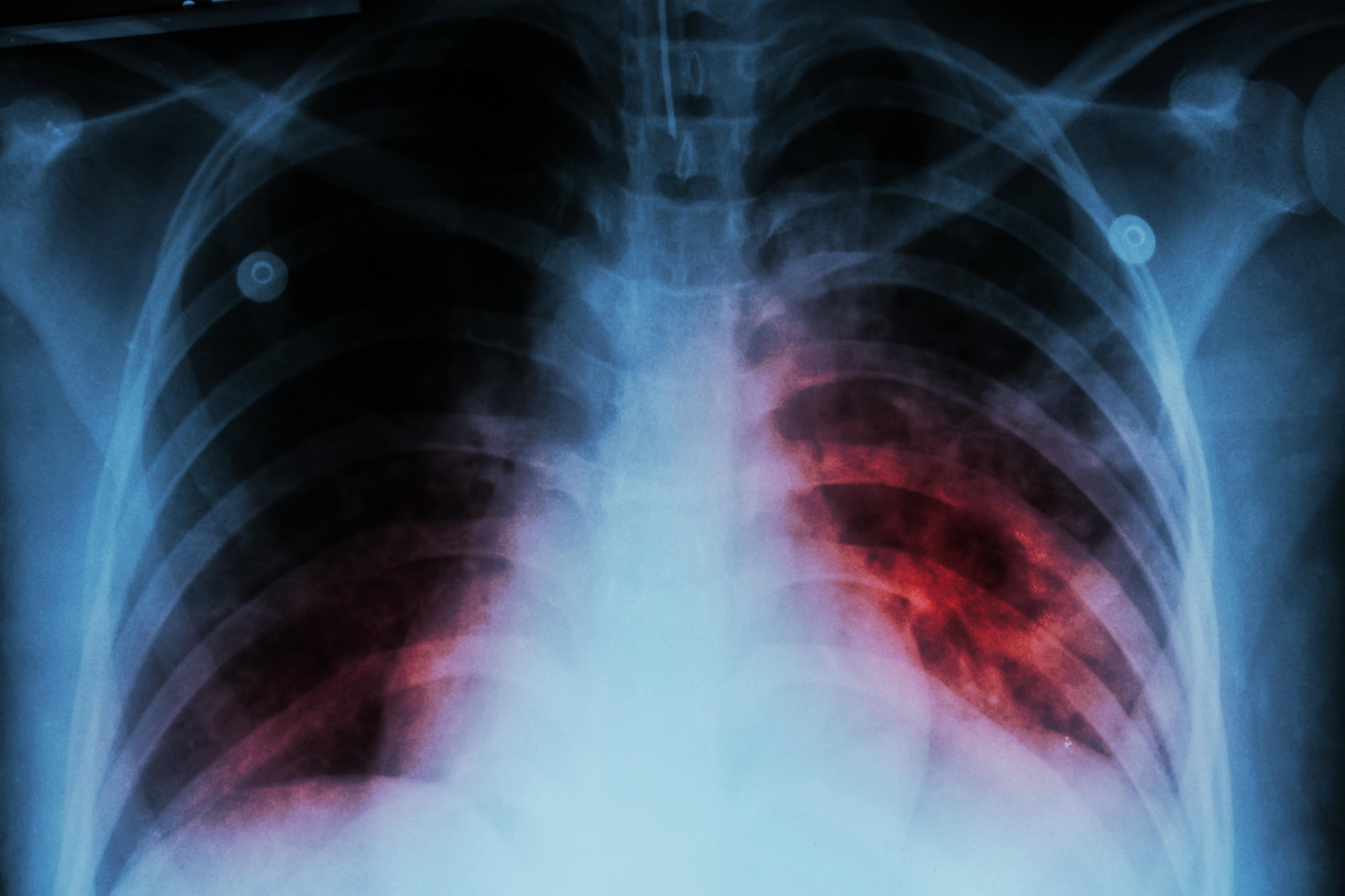 Preocupa el aumento de la tuberculosis en la Argentina: advierten sobre la importancia del diagnóstico temprano