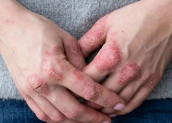 ANMAT aprobó una nueva terapia oral para la artritis psoriásica