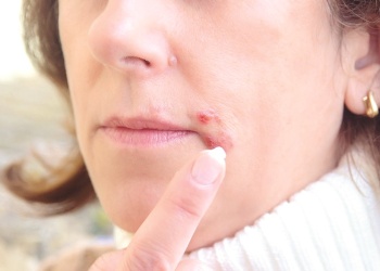 HERPES ¿qué hacer?