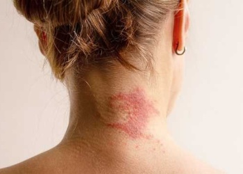 Dermatitis atópica: las dificultades para sostener la atención y el tratamiento