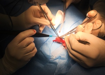 Actualizan criterios para la lista de espera de trasplante hepático: qué cambia