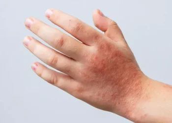 Dermatitis atópica: una enfermedad frecuente que puede afectar profundamente la calidad de vida
