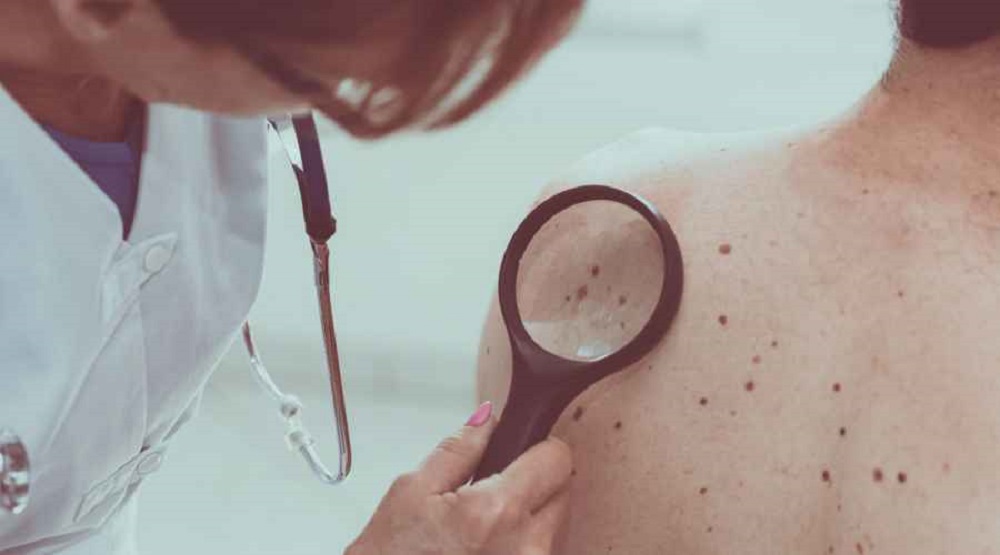 Cáncer de Piel